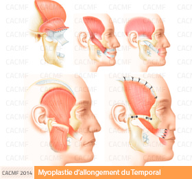 Myoplastie d'allongement du Temporal