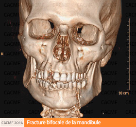 Fracture de la mandibule