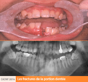 Fractures de la portion dentée